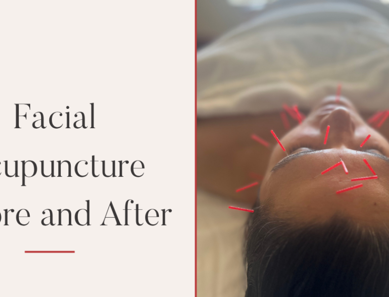 Facial Acupuncture Before and After